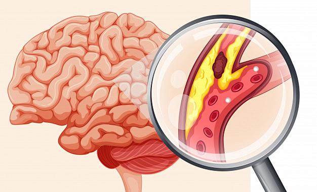 高血压、心脏病等患者需警惕卒中 专家：“脑心同治”是关键